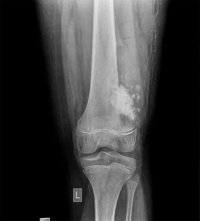 Osteosarcoma