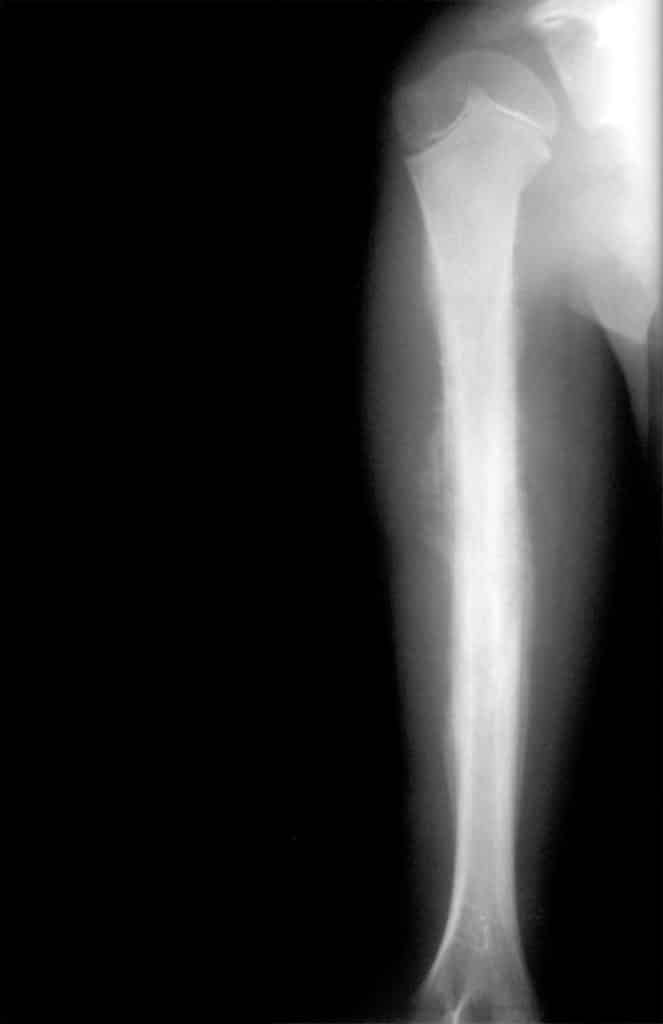 Sarcoma de Ewing