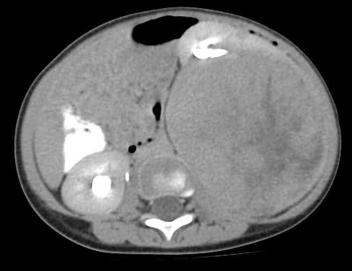 Tumor de Wilms