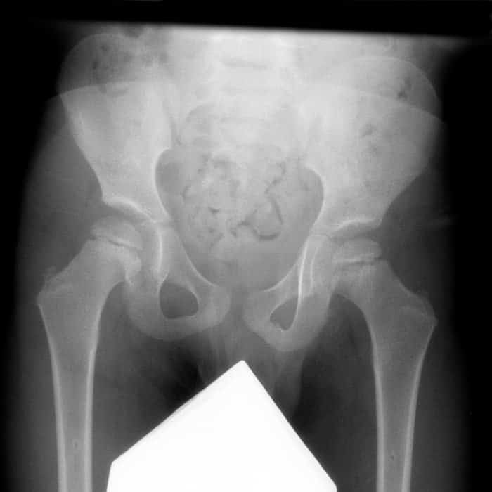 Enfermedad de Legg-Calvé-Perthes