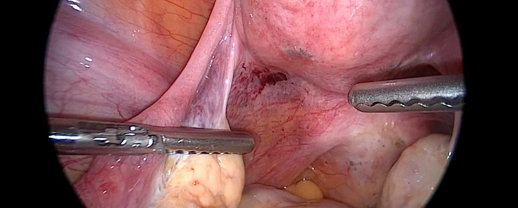 Endometriosis