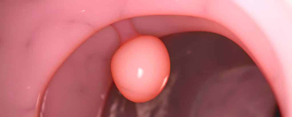 Patología Cervical Benigna