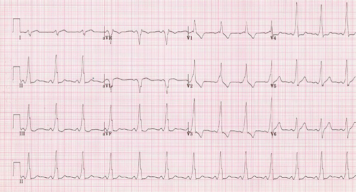 Wolff-Parkinson-White en el ECG
