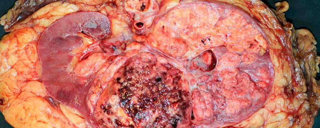Carcinoma de células renales