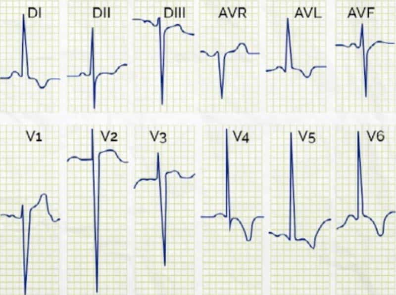 ECG, hipertrofia ventricular izquierda