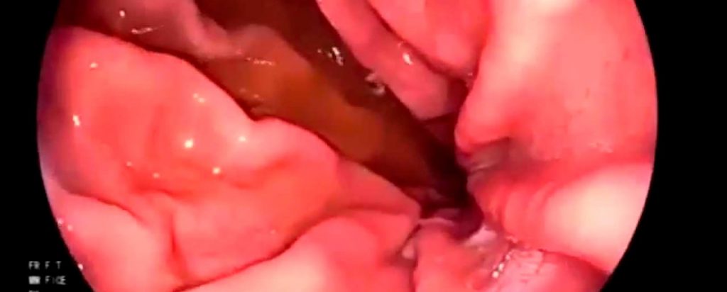 Enfermedad por reflujo gastroesofágico