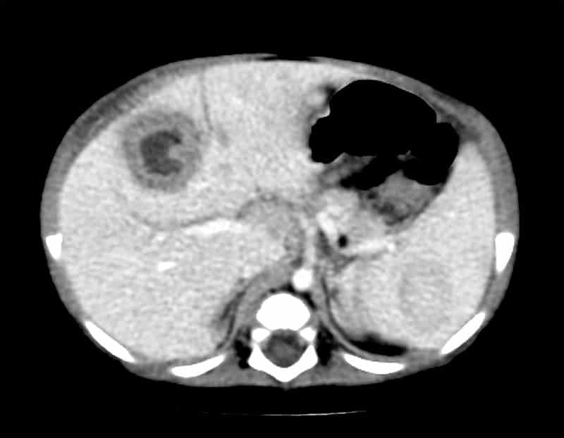 Absceso hepático amebiano TAC