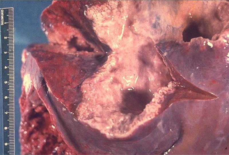 Absceso hepático amebiano