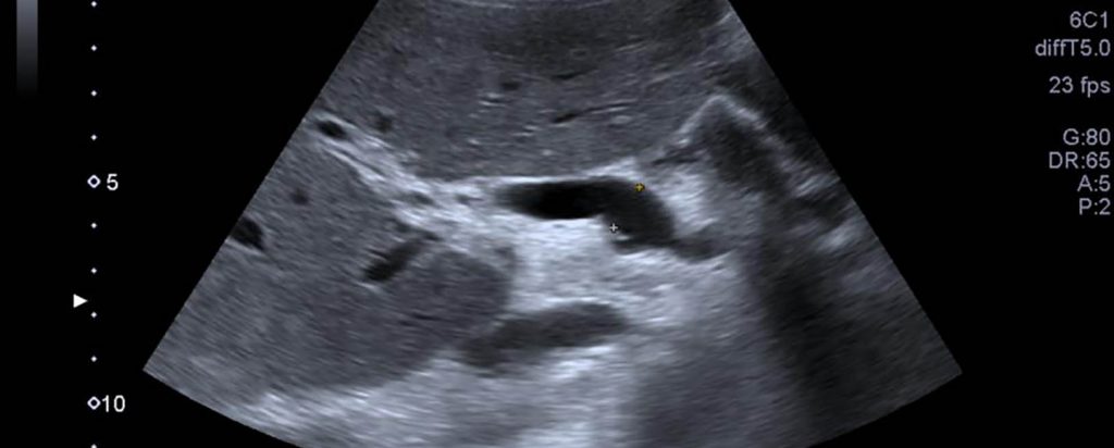 Colelitiasis, Colecistitis, Coledocolitiasis y Colangitis.
