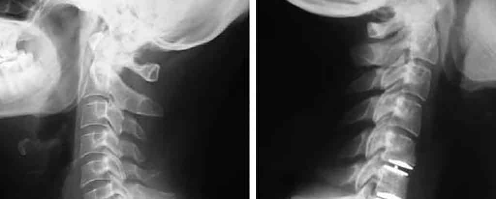 Esguince Cervical