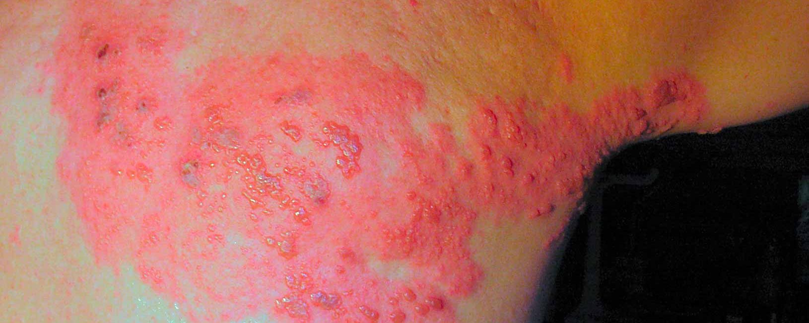 Herpes Simple, Coxsackie, Molusco Contagioso y Virus del Papiloma Humano en Dermatología.