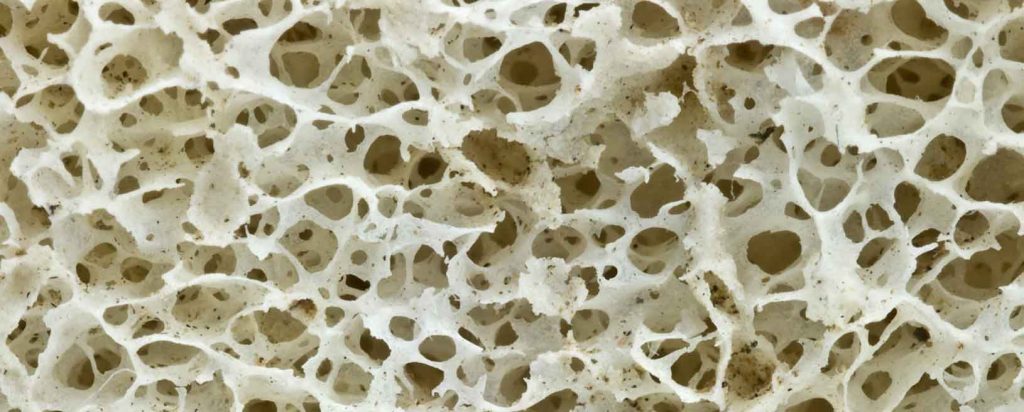 Osteoporosis