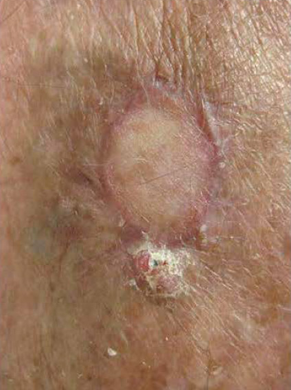 Carcinoma Escamocelular
