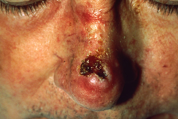 Carcinoma Escamocelular