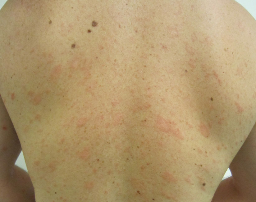 Pitiriasis rosada