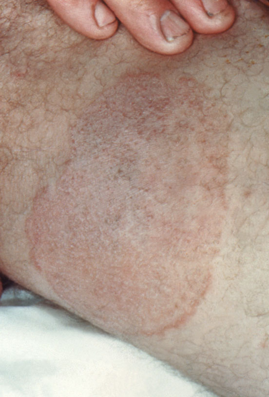 Tinea corporis