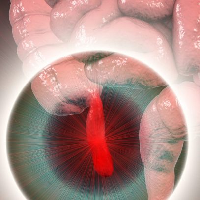Sepsis Abdominal y Abdomen Catastrófico