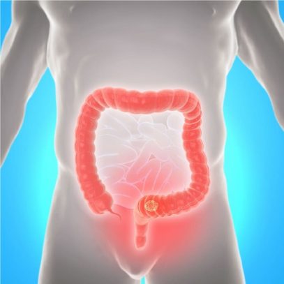 Coloproctología Básica para el Cirujano General