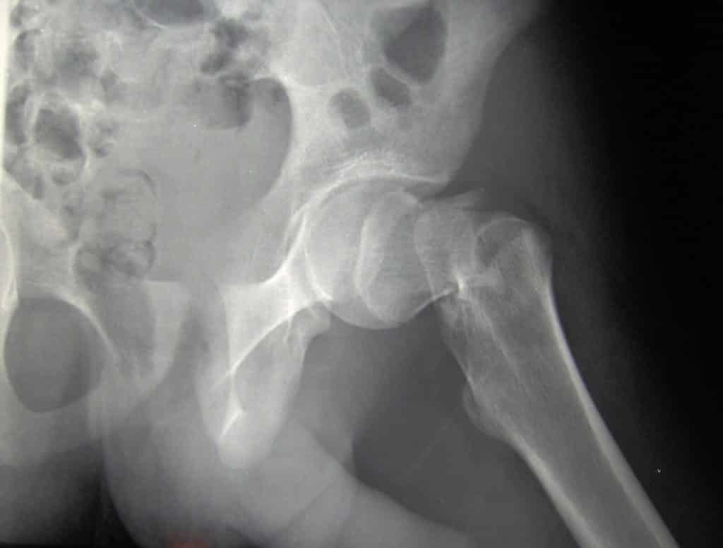 Fx de la cabeza femoral