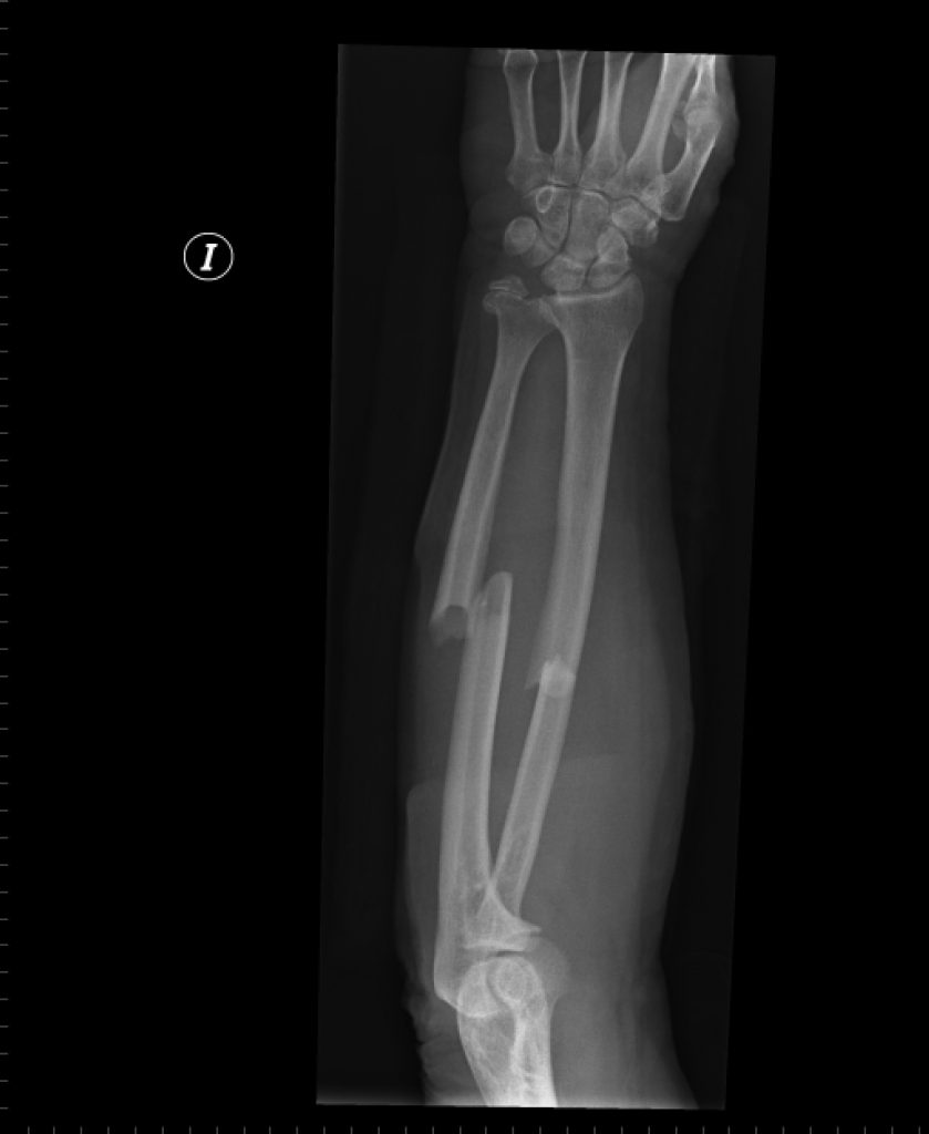 Fractura de cúbito y radio